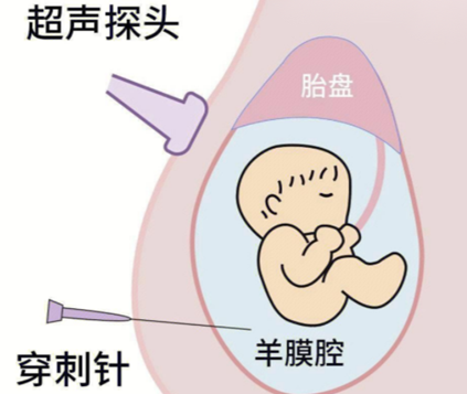 高龄怀孕怕胎儿异常？羊水穿刺排查这些风险
