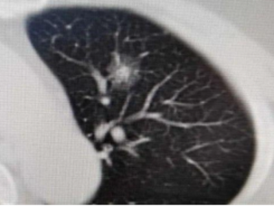 放射科医生带你科学解读肺部结节