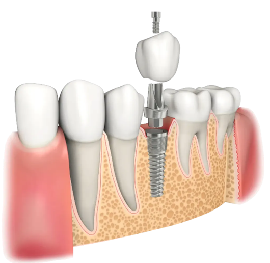 种牙怕疼、怕失败？AI+机器人组合给你一颗“稳稳的”新牙