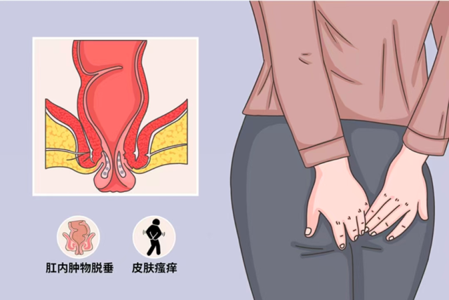 直肠脱垂：那些你可能不知道的肛门“危机”