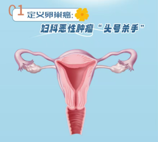 从“隐形”到“显形”卵巢癌防治的精准狙击战｜医图读懂