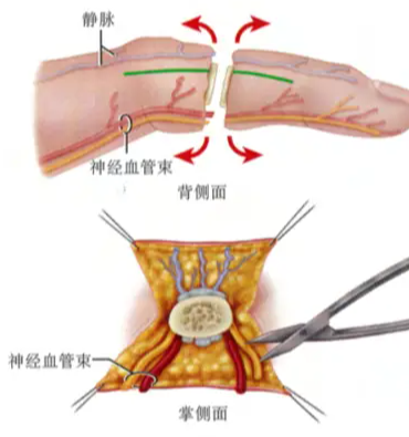手指的第二次生命：断指再植后的血管训练营