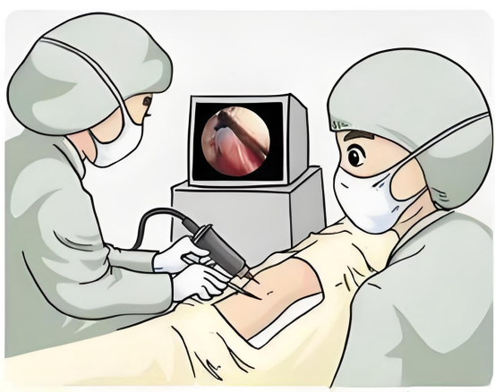 单孔胸腔镜：肺部手术的隐形艺术