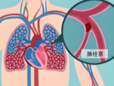 警惕致命三角：腿肿、胸痛、憋气与肺栓塞