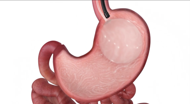 胃里放“水球”2个月瘦50斤？新型减重方式“保真”吗｜健康深一度