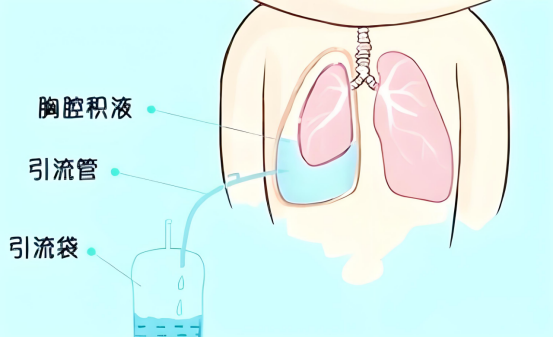 胸腔里的小水泵:术后胸腔积积液为何要放管?