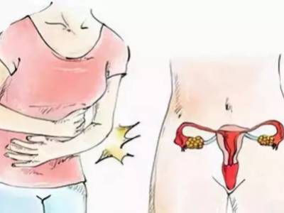 揭开子宫里的“小石头”——子宫肌瘤的真面目