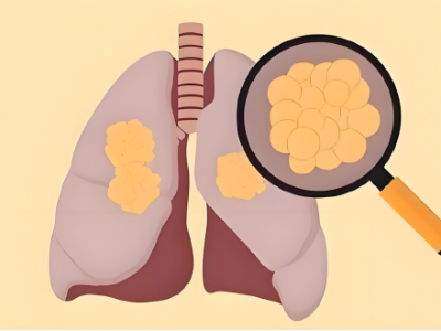 体检查出“肺结节”，别慌！一图教你看懂CT报告上的“良恶性密码”