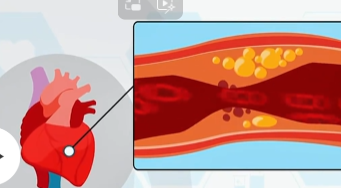 心影相随：急性心肌梗死的防治｜医视频