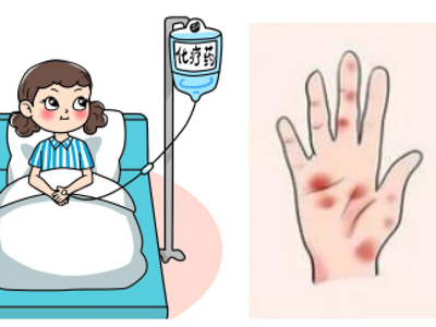 化疗“手足”保卫战：别让“袜子”和“鞋子”出卖你的痛苦