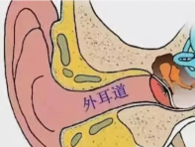 外耳道炎预防与处理：掏耳朵的那些“坑”要避开