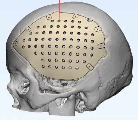 3D打印“新颅骨”，患者重拾自信。&nbsp; &nbsp; 受访者供图