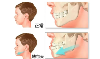 孩子乳牙没换完,为啥医生就建议做牙齿矫正?