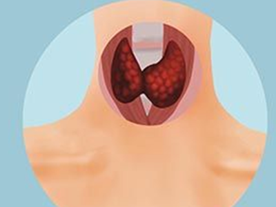 甲状腺癌被称为“懒癌”，就可以掉以轻心吗？