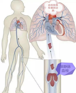 介入治疗对付肺栓塞这个“沉默的杀手”
