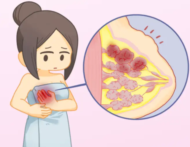 乳腺肿块有“伪装”?年轻女性快速识别高危&隐藏款