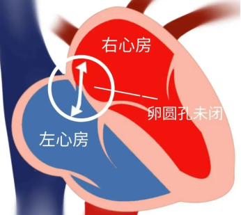 右心声学造影是什么?几分钟排查隐匿心脏问题