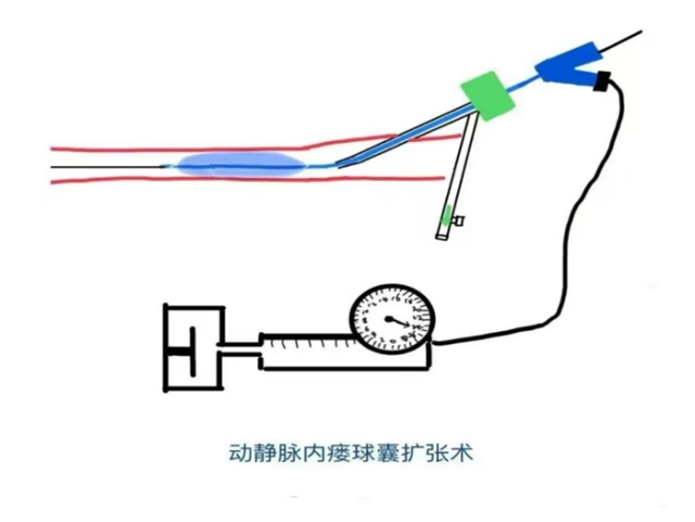 透析通路维护新选择:动静脉瘘球囊扩张术到底好在哪