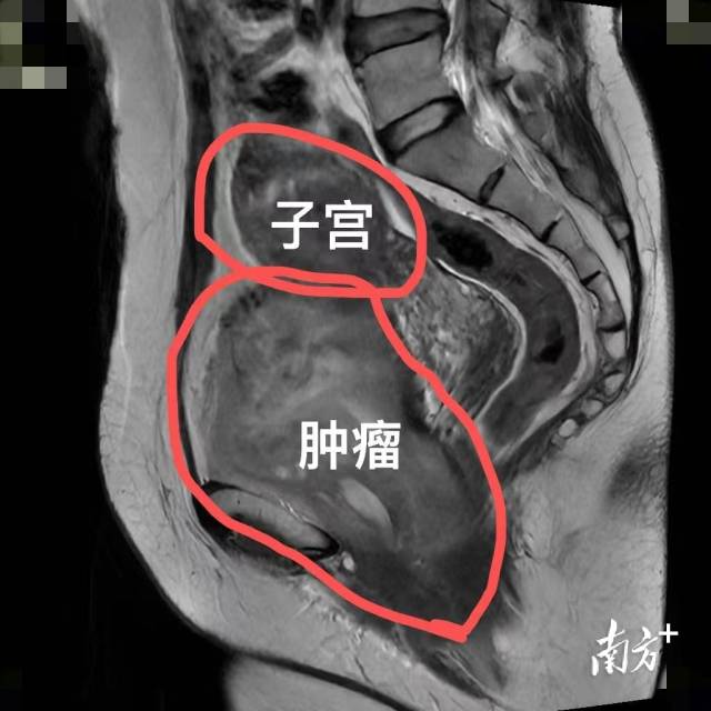检查显示肿瘤的位置。 检查显示肿瘤的位置。