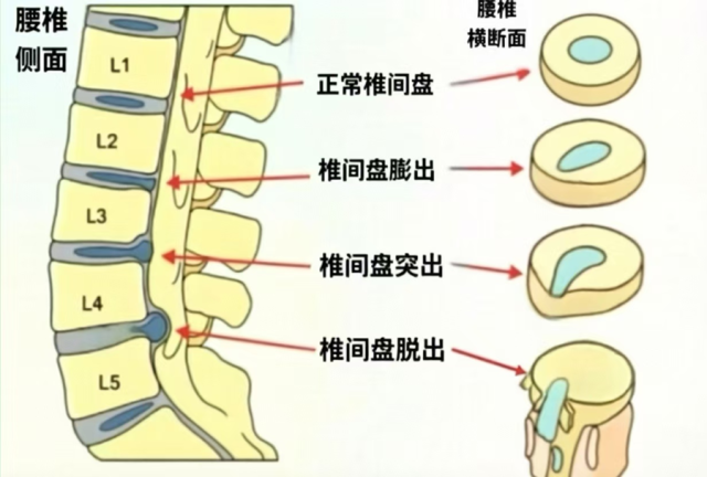懂腰椎影像报告,科学防治腰间盘突出