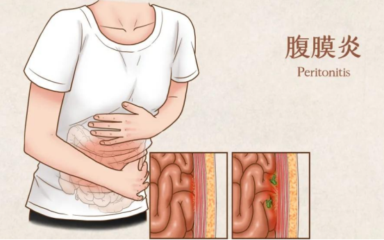 夏日腹透患者的“防炎”保卫战