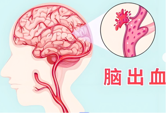 脑出血的中医“急救与康复”全攻略