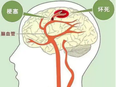 同样是脑梗，为什么有人溶栓有人介入治疗？
