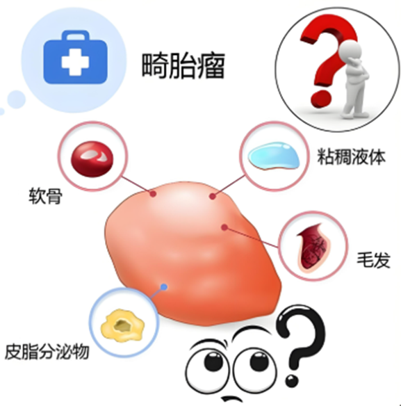 体检CT查出“小怪物”?一文看懂畸胎瘤的CT“长相”