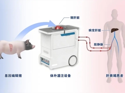 基因编辑猪肝“顶班”66小时，肝衰竭患者绝处逢生丨器官医学的“超能力”②