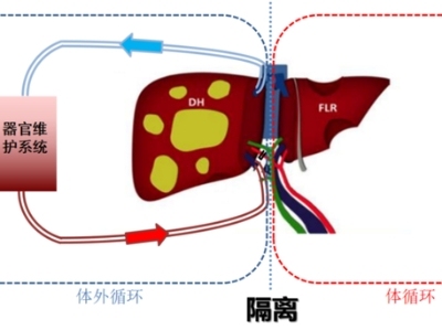 隔离病肝单独“吃药”，精准围剿肿瘤不伤身丨器官医学的“超能力”③