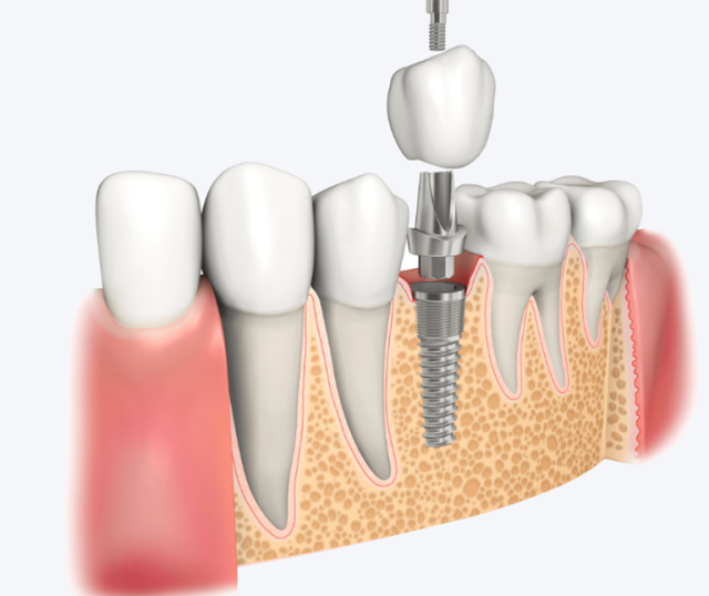 种植牙能用一辈子吗？