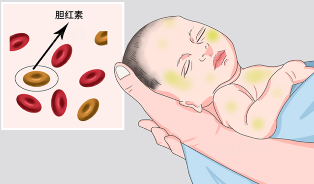 胆汁淤积,早产儿大多能恢复吗?
