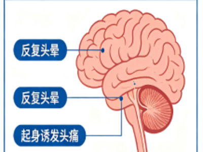 头晕头痛别硬扛，哪些情况要警惕脑出血找上门