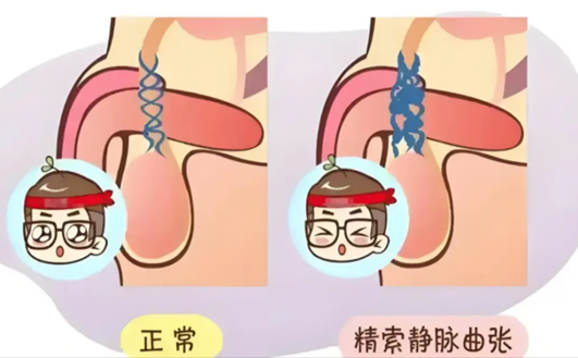 阴囊坠胀暗藏隐患，认清精索静脉曲张及时治疗护生育