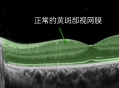 做完近视手术，就不会得眼底病了吗？