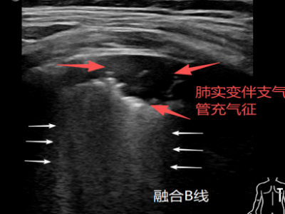 新生儿肺超声：一场比X光更温柔的“肺部直播”